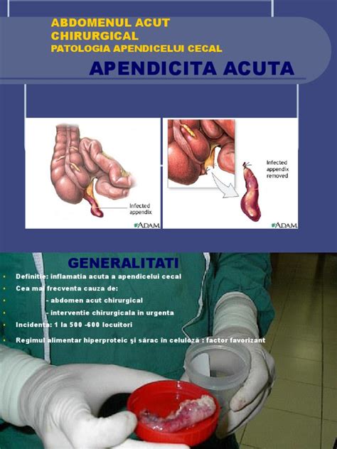 apendicita acuta|Apendicita